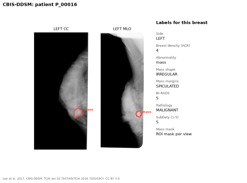 CC and MLO scanned film mammograms with a red outline around a mass, and the list of labels