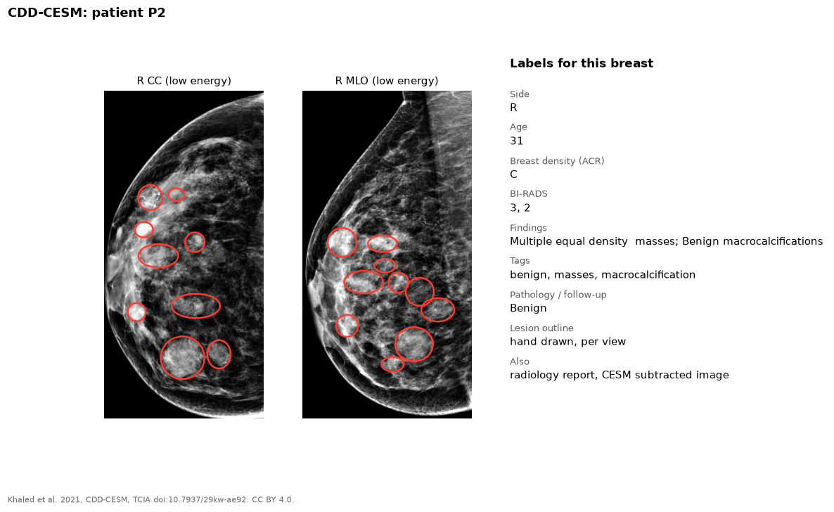 Low-energy CC and MLO mammograms with red outlines around many masses, and the list of labels