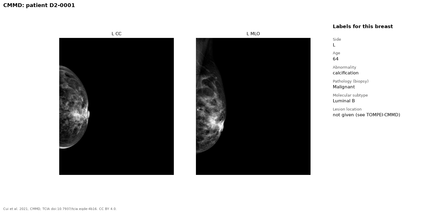 CC and MLO mammograms of a left breast, and the list of CMMD labels