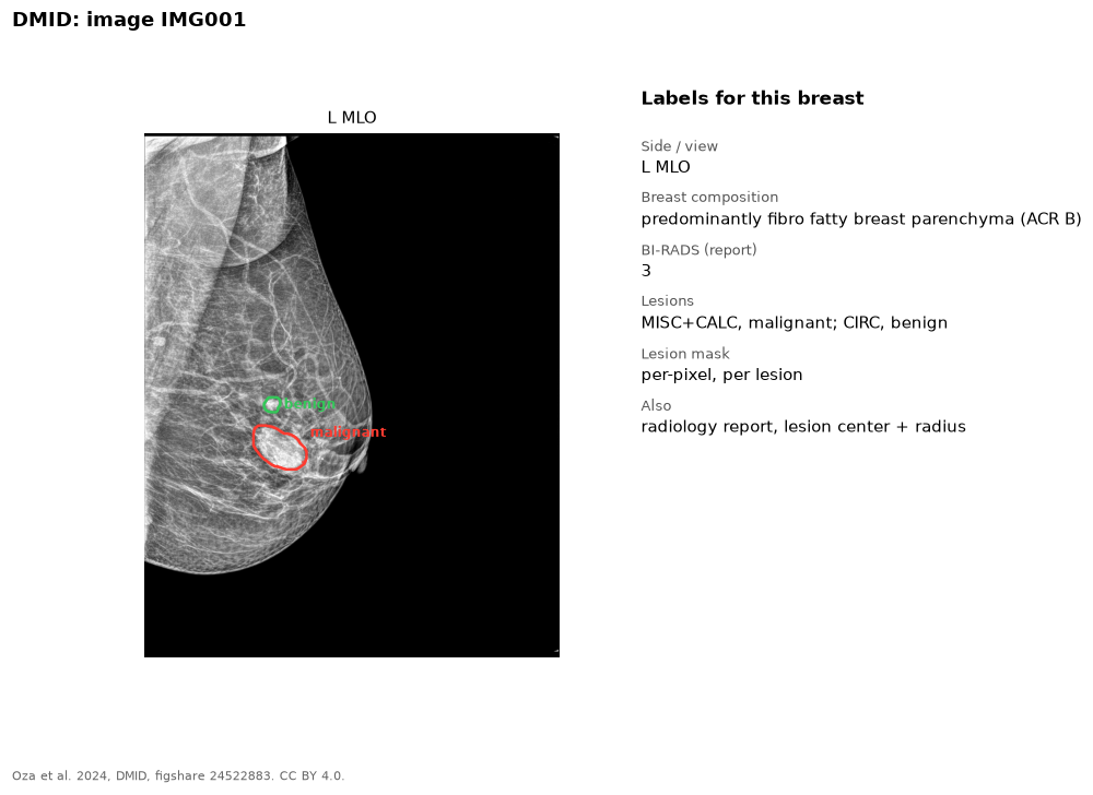 MLO mammogram with a red outline around a malignant lesion and a green outline around a benign lesion, and the list of labels