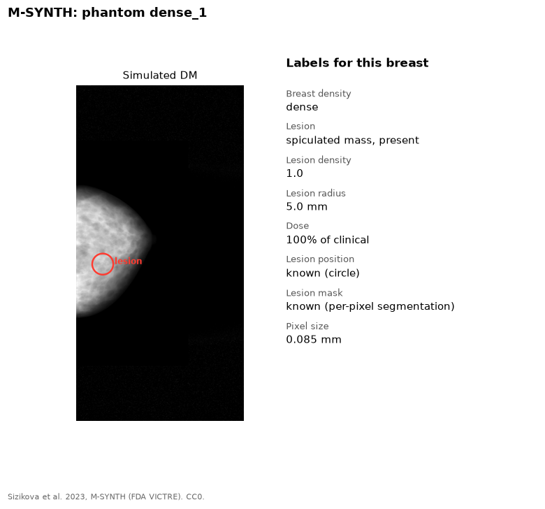 Simulated mammogram of a dense breast with a red circle around the lesion, and the list of labels