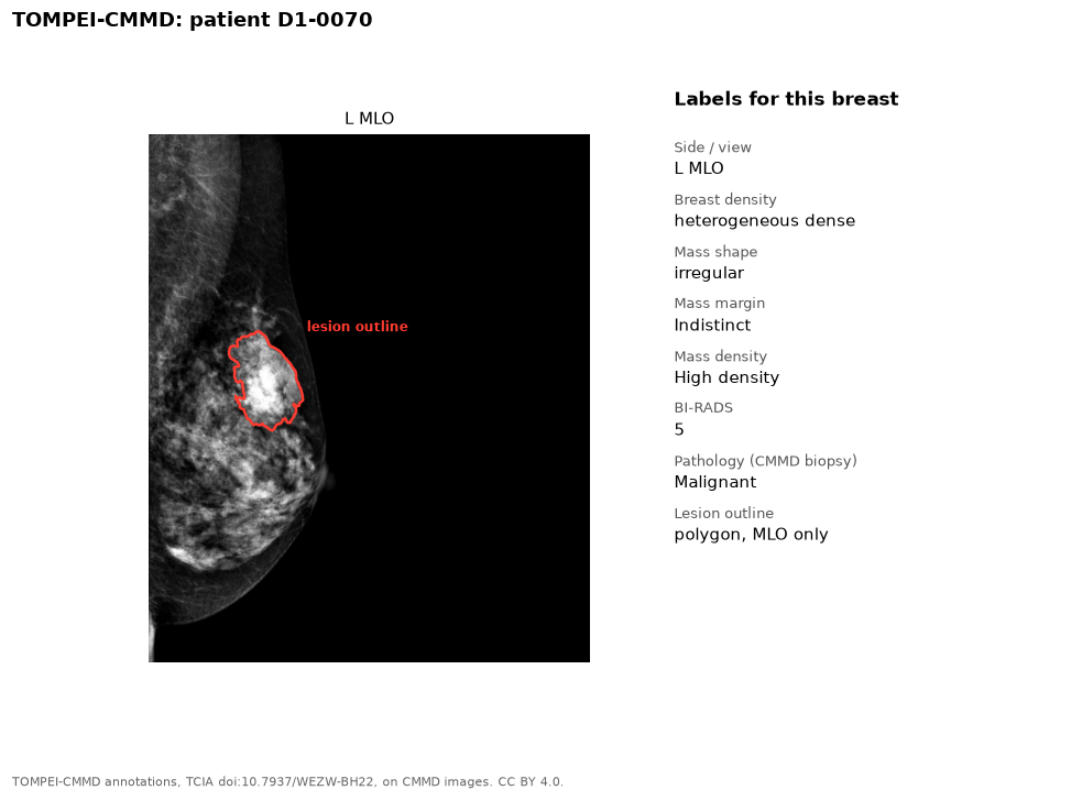 MLO mammogram with a red outline around a mass, and the list of labels